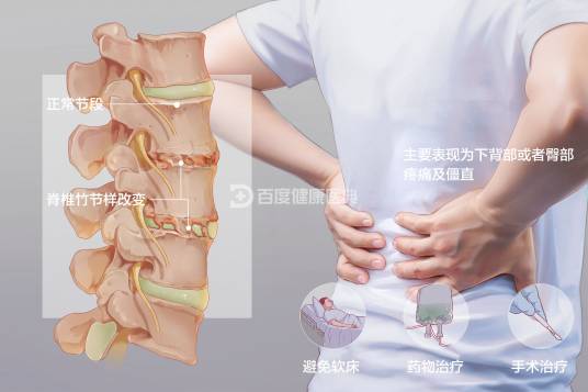 强直性脊柱炎（疾病症状）