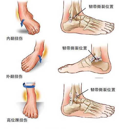 习惯性崴脚