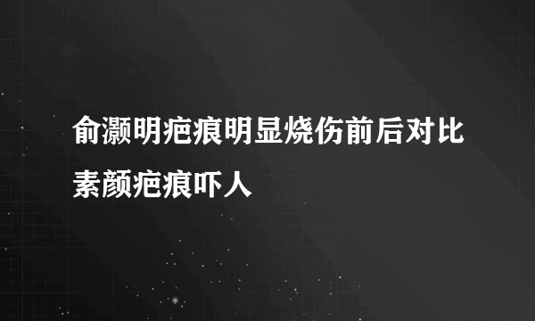 俞灏明疤痕明显烧伤前后对比素颜疤痕吓人