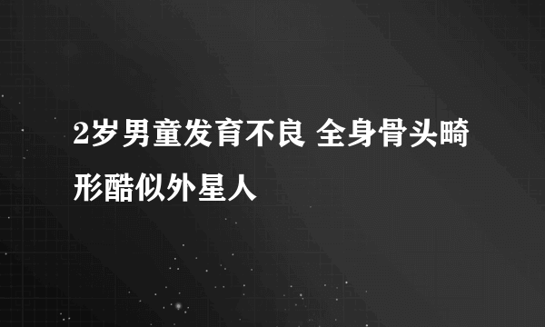 2岁男童发育不良 全身骨头畸形酷似外星人