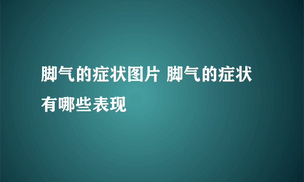 脚气的症状图片 脚气的症状有哪些表现