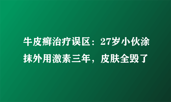 牛皮癣治疗误区：27岁小伙涂抹外用激素三年，皮肤全毁了