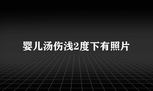 婴儿汤伤浅2度下有照片