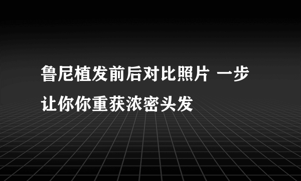 鲁尼植发前后对比照片 一步让你你重获浓密头发