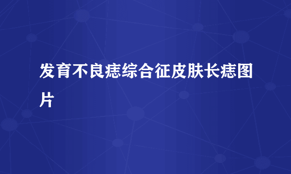 发育不良痣综合征皮肤长痣图片