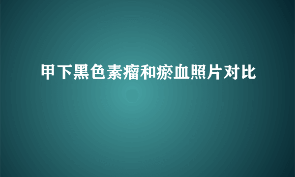 甲下黑色素瘤和瘀血照片对比