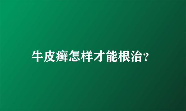 牛皮癣怎样才能根治？