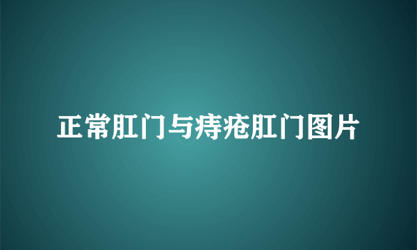 正常肛门与痔疮肛门图片